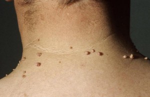 Папилломы в области шеи